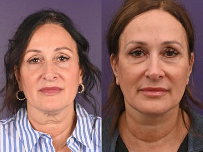 Office Facelift Before & After Gallery - Patient 210968 - Image 1