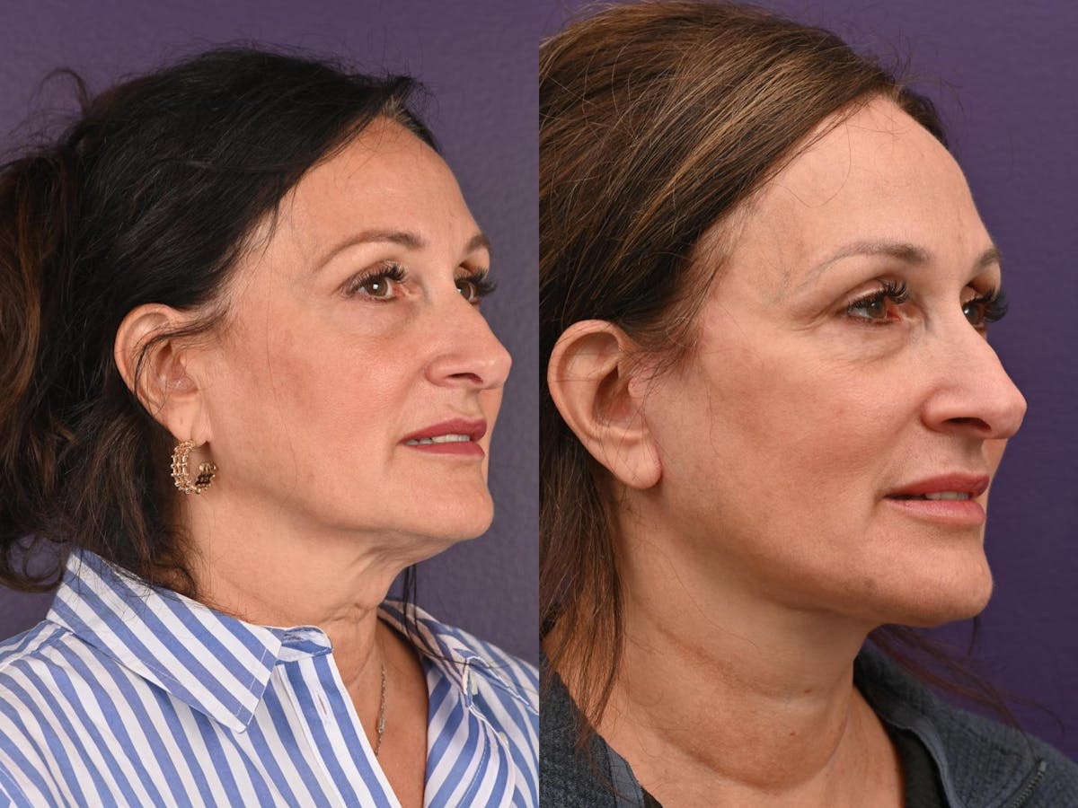 Office Facelift Before & After Gallery - Patient 210968 - Image 2