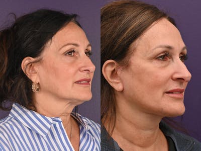 Office Facelift Before & After Gallery - Patient 304160 - Image 1