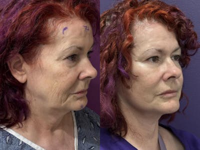 Office Facelift Before & After Gallery - Patient 257211 - Image 1
