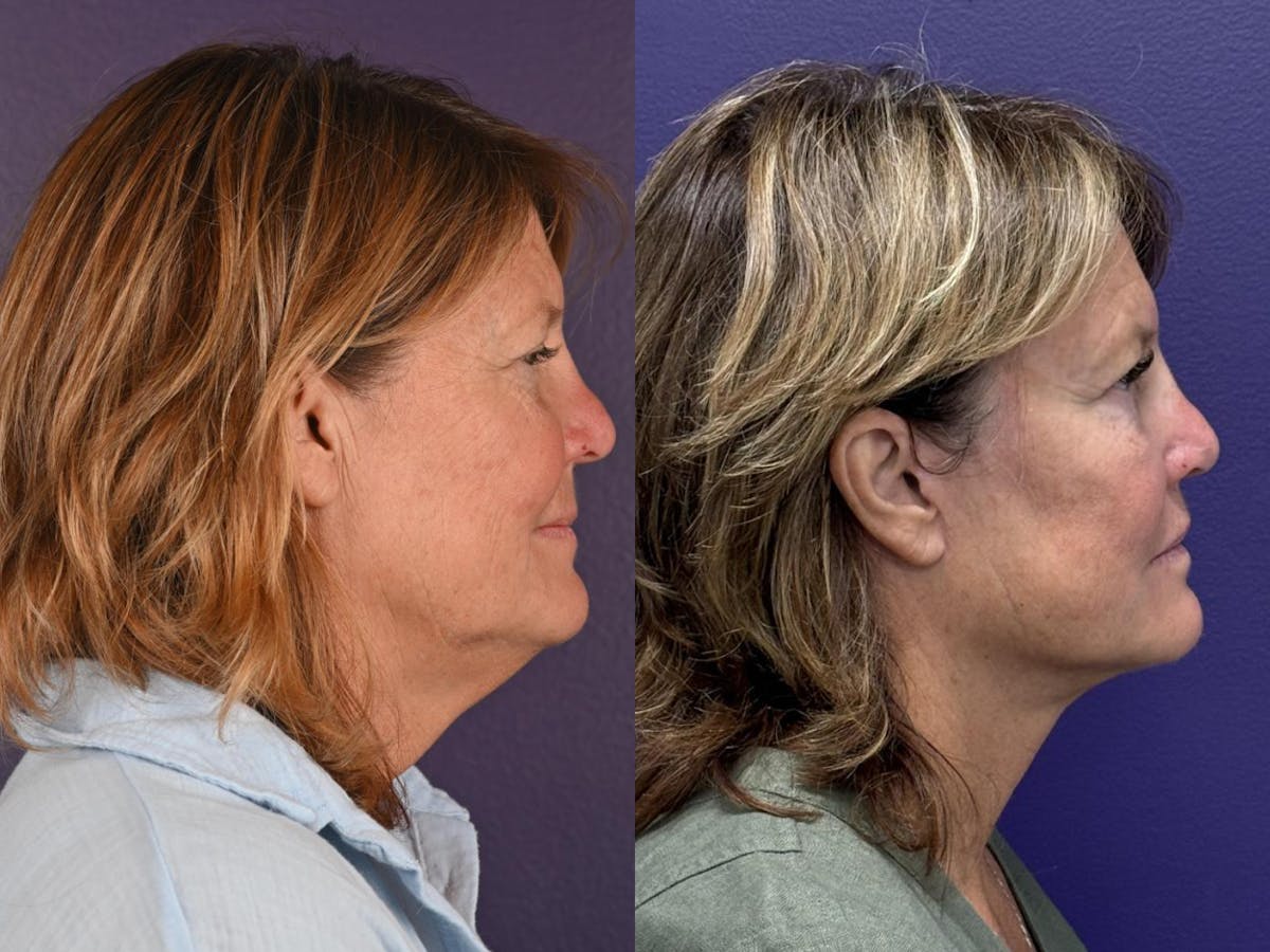 Office Facelift Before & After Gallery - Patient 317794 - Image 1