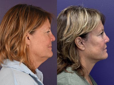 Office Facelift Before & After Gallery - Patient 317794 - Image 1