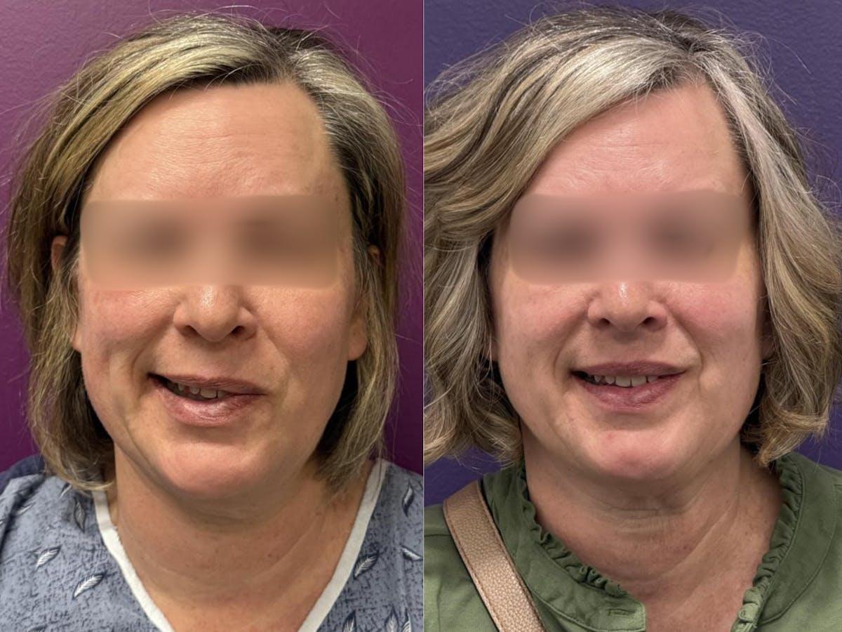 Denervation Before & After Gallery - Patient 257753 - Image 1