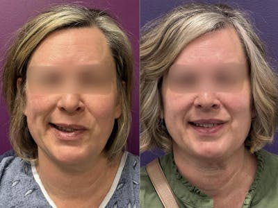 Denervation Before & After Gallery - Patient 257753 - Image 1
