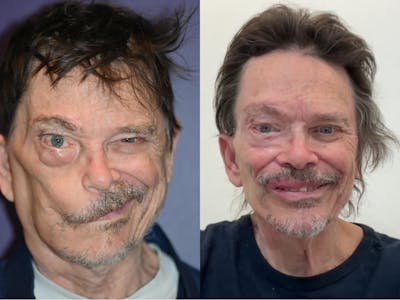 Gracilis Before & After Gallery - Patient 222966 - Image 1