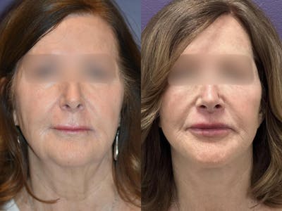 Lip Lift Before & After Gallery - Patient 782594 - Image 1