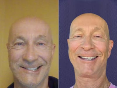 Facial Nerve Repair Before & After Gallery - Patient 135880 - Image 1
