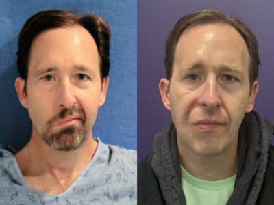 Static Suspension  Before & After Gallery - Patient 299432 - Image 1