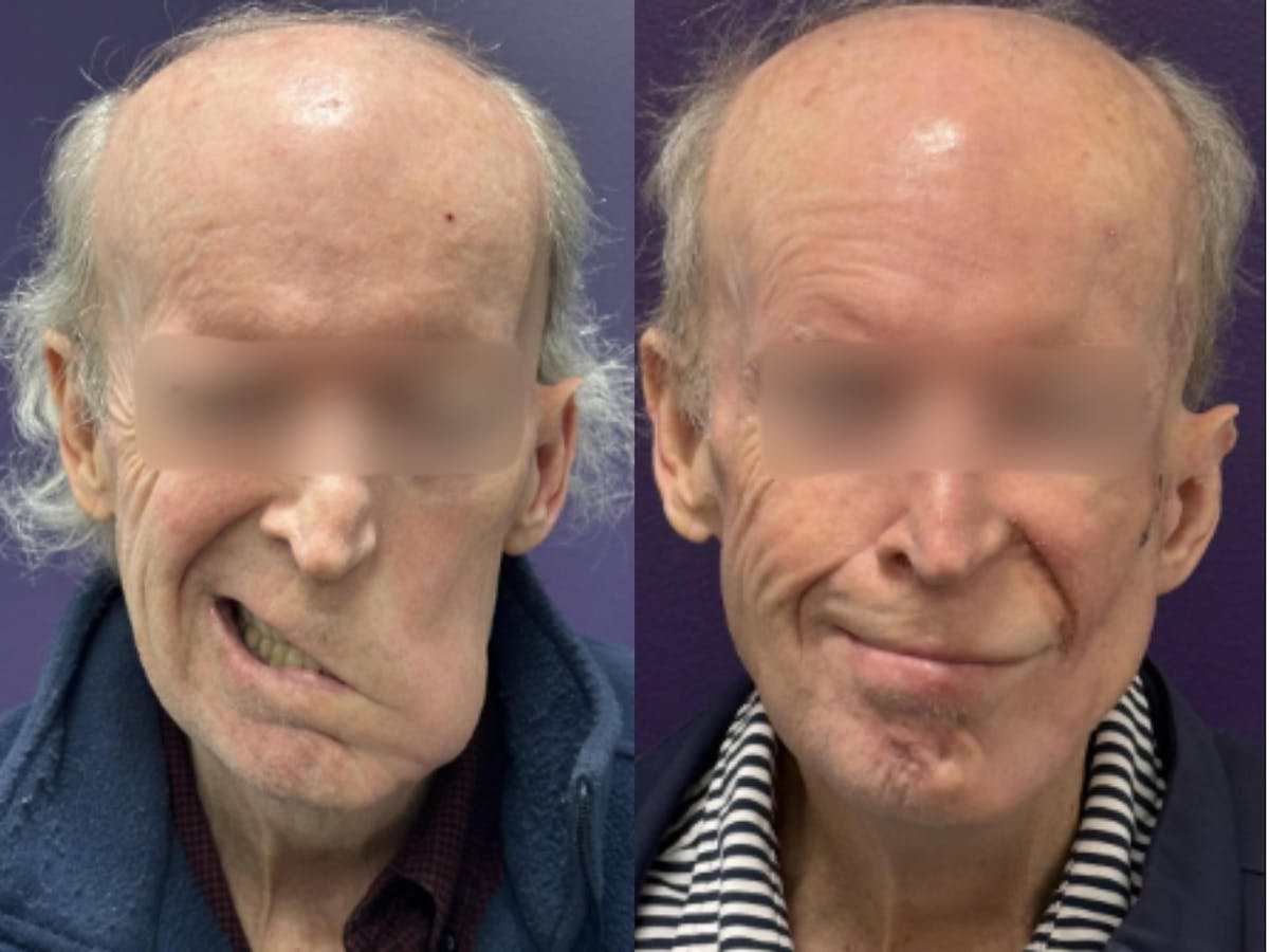 Static Suspension  Before & After Gallery - Patient 278540 - Image 1