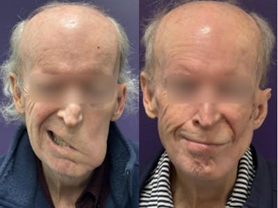 Static Suspension  Before & After Gallery - Patient 278540 - Image 1