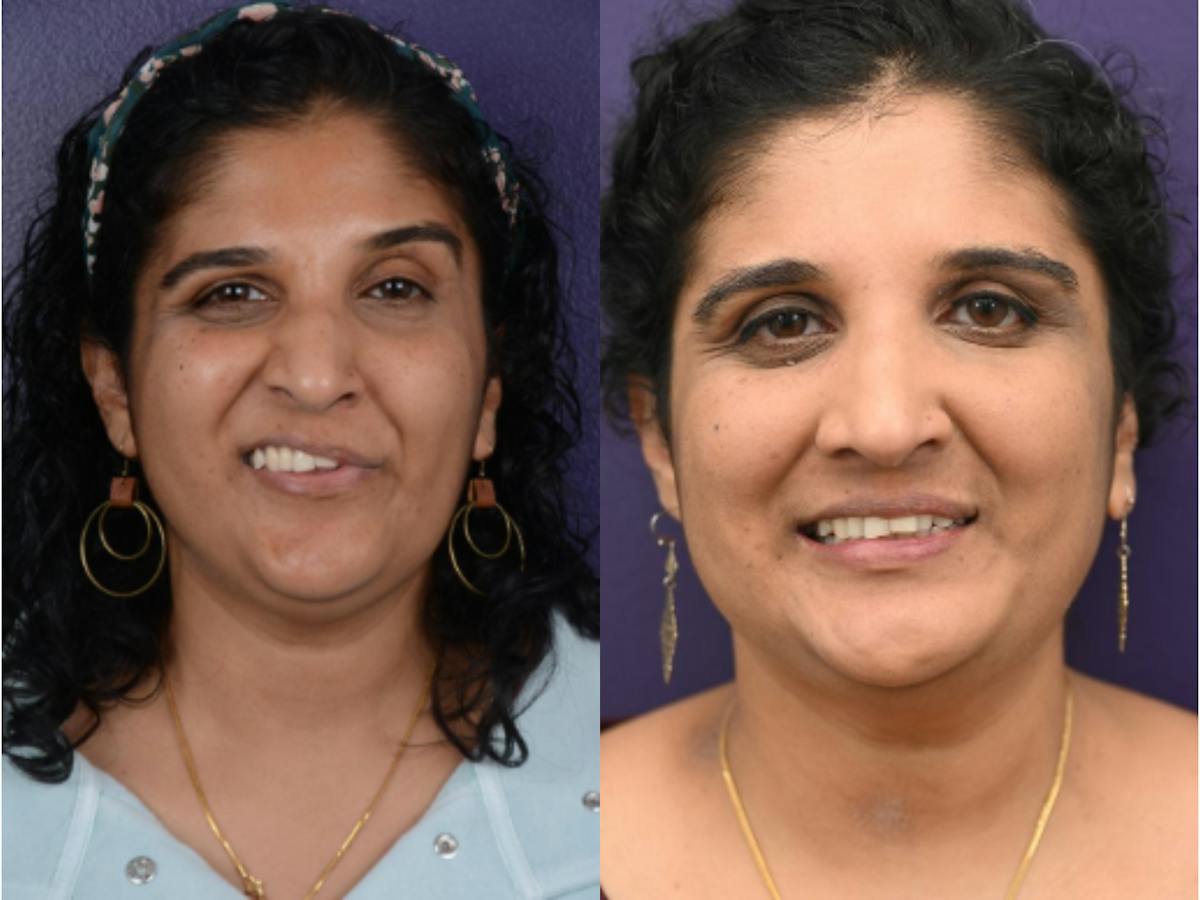 Denervation Before & After Gallery - Patient 324150 - Image 1