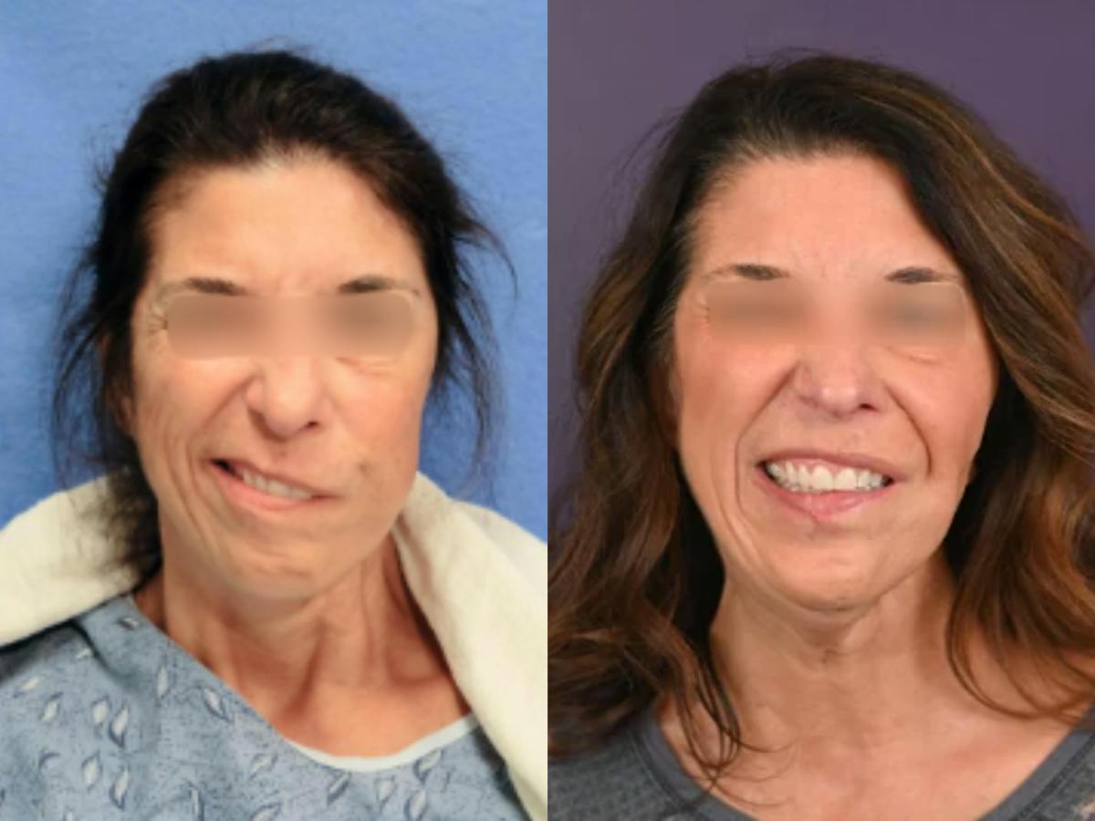 Gracilis Before & After Gallery - Patient 190933 - Image 1
