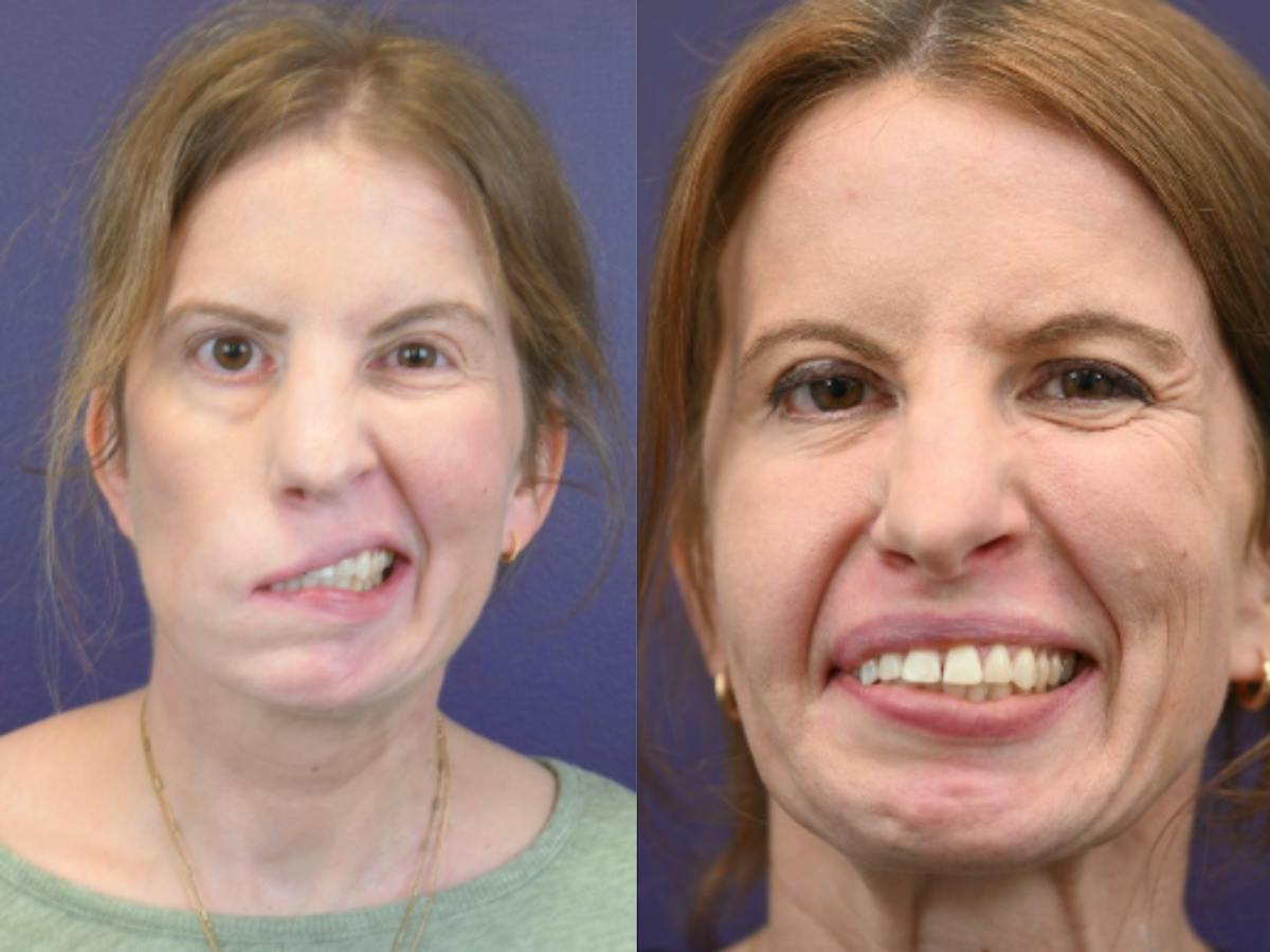 Gracilis Before & After Gallery - Patient 274403 - Image 1