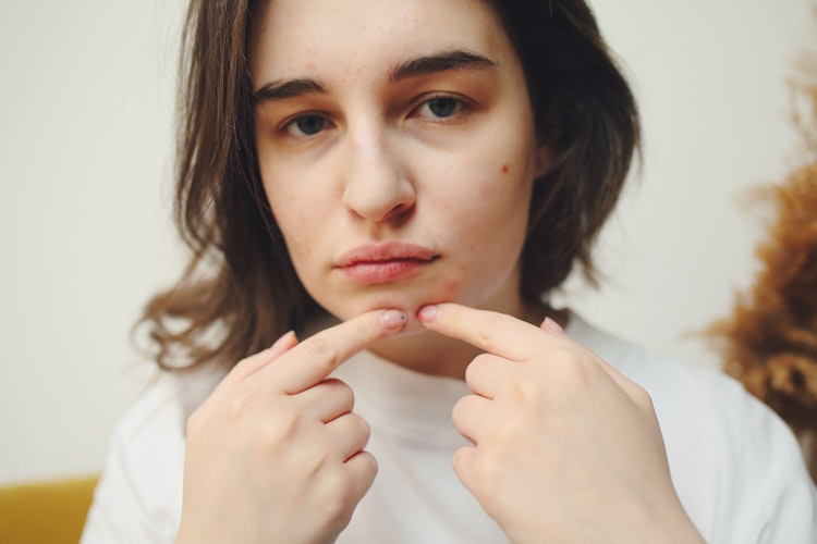 an image of Why does my daughter get spots before her period? article