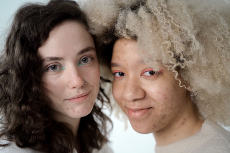 an image of Why has my daughter got hormonal acne? article