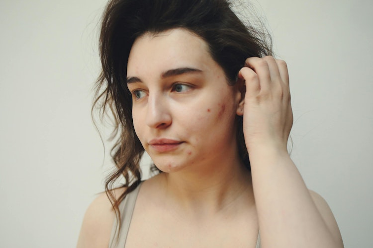 an image of How to stop my daughter's acne from leaving scars article