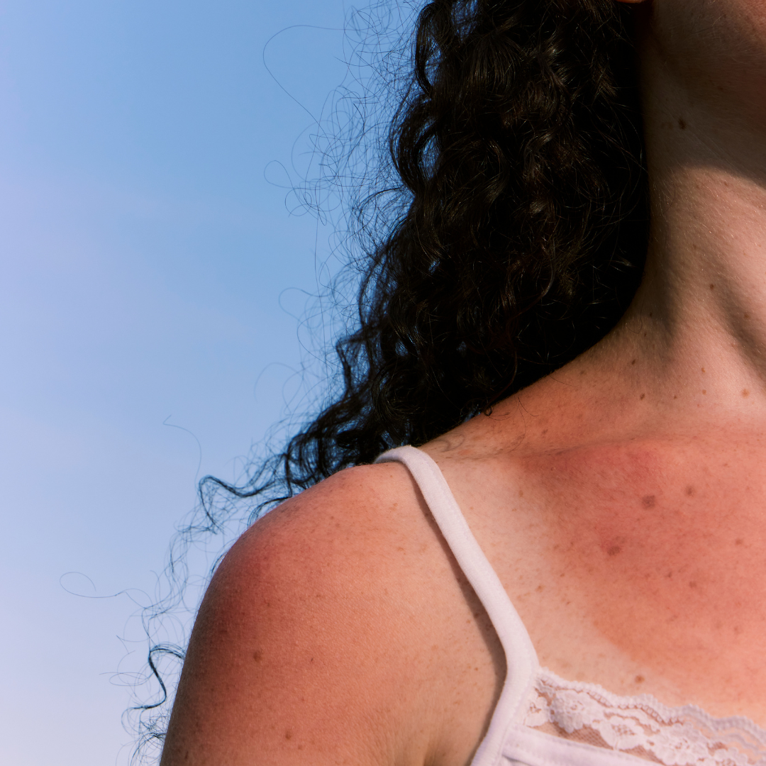 Close-up of a girl's sunburnt shoulder and neck against a blue sky, with curly dark hair falling over her shoulder.