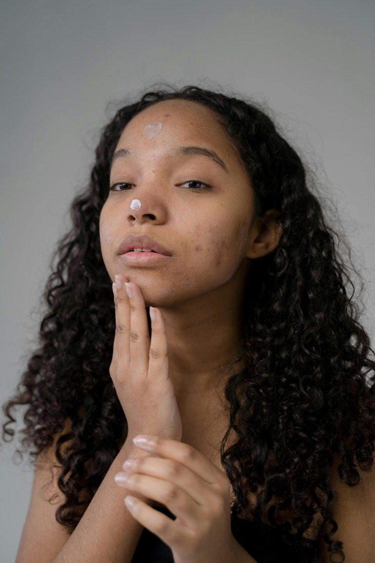 Teenage girl with curly hair applying spot cream to acne on her face.