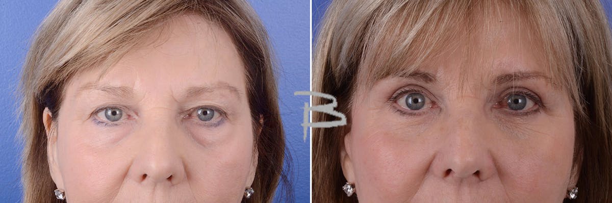 Blepharoplasty Before & After Gallery - Patient 192276561 - Image 1