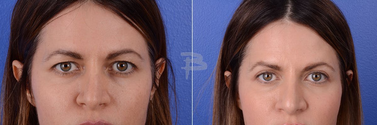 Blepharoplasty Before & After Gallery - Patient 192276612 - Image 1