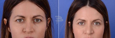 Blepharoplasty Before & After Gallery - Patient 192276612 - Image 1