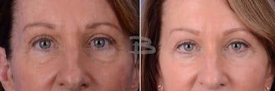Blepharoplasty Before & After Gallery - Patient 192276639 - Image 1