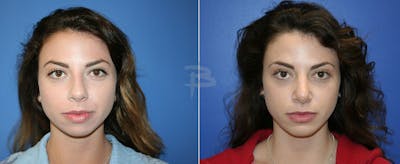 Rhinoplasty Before & After Gallery - Patient 192276690 - Image 1