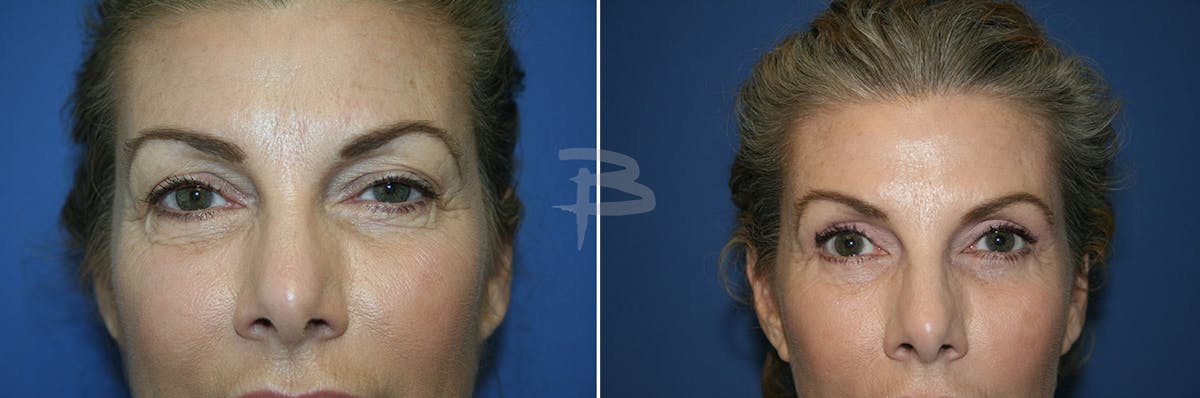 Blepharoplasty Before & After Gallery - Patient 192276685 - Image 1