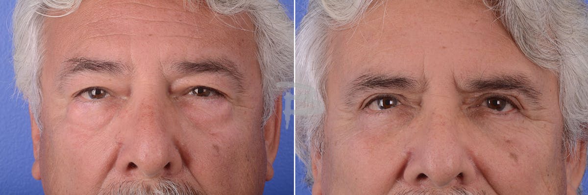 Blepharoplasty Before & After Gallery - Patient 192276741 - Image 1
