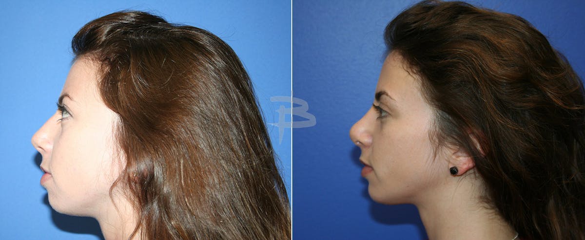 Rhinoplasty Before & After Gallery - Patient 192276742 - Image 1