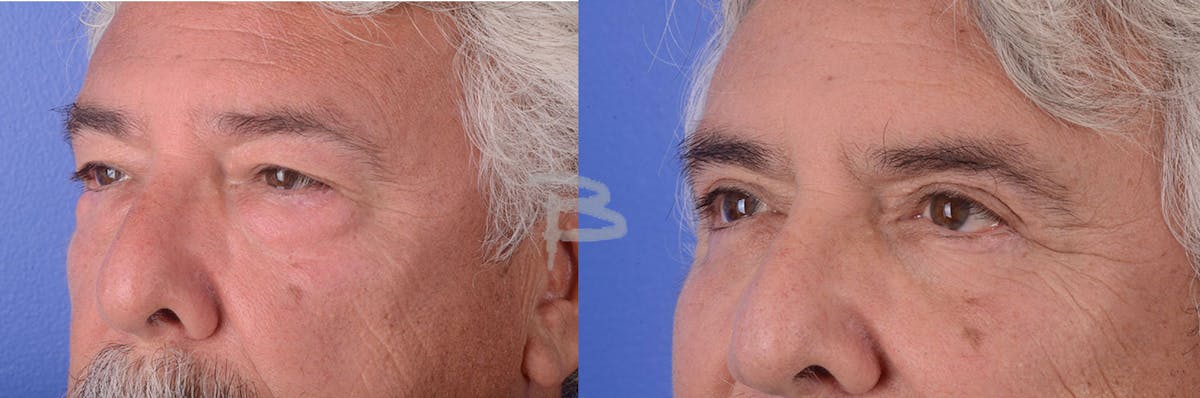 Blepharoplasty Before & After Gallery - Patient 192276759 - Image 1