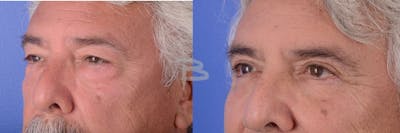 Blepharoplasty Before & After Gallery - Patient 192276759 - Image 1