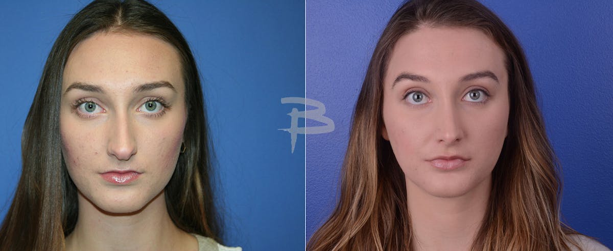 Rhinoplasty Before & After Gallery - Patient 192276772 - Image 1