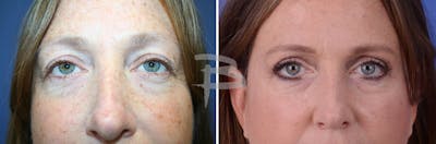 Blepharoplasty Before & After Gallery - Patient 192276783 - Image 1