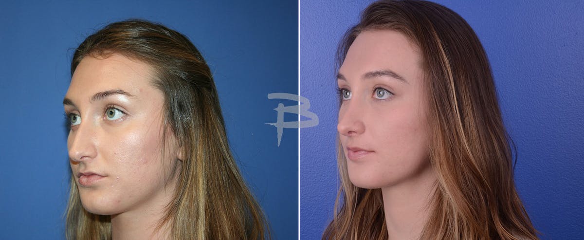 Rhinoplasty Before & After Gallery - Patient 192276809 - Image 1