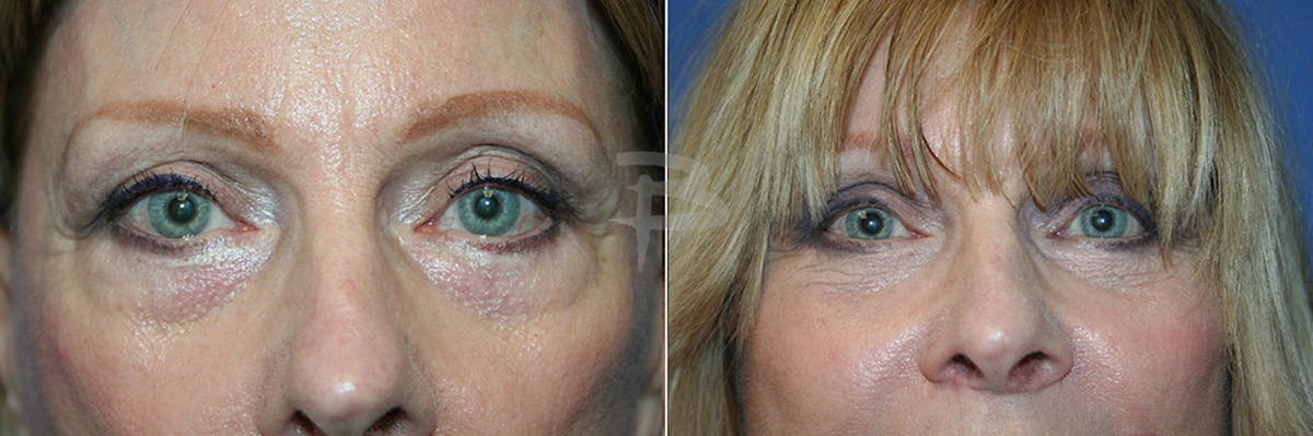 Blepharoplasty Before & After Gallery - Patient 192276813 - Image 1