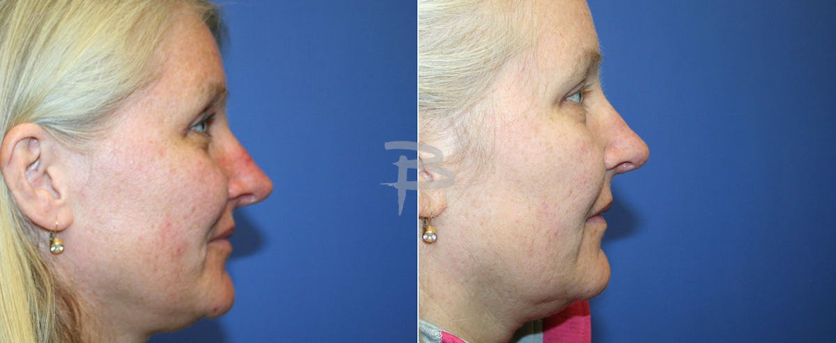 Rhinoplasty Before & After Gallery - Patient 192276836 - Image 1