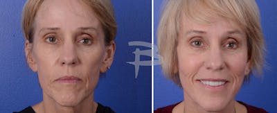 Facial Fat Grafting Before & After Gallery - Patient 192276847 - Image 1