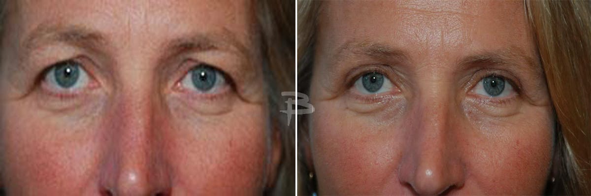 Blepharoplasty Before & After Gallery - Patient 192276885 - Image 1