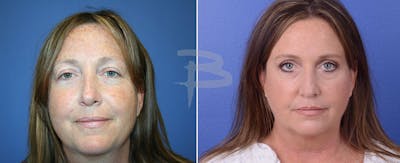 Facial Fat Grafting Before & After Gallery - Patient 192276880 - Image 1