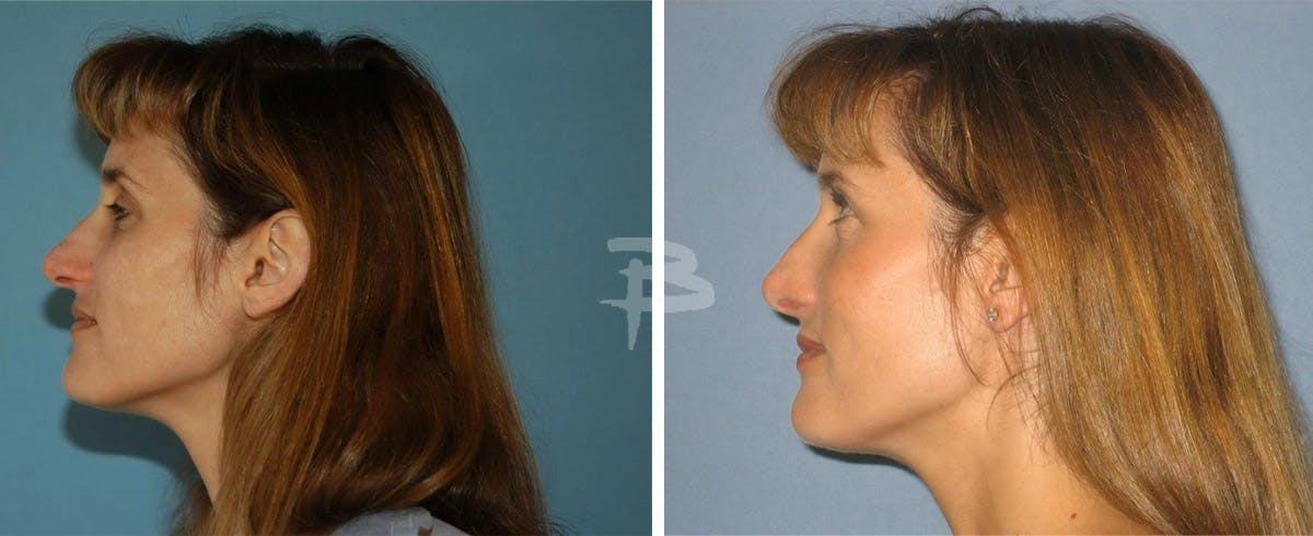 Rhinoplasty Before & After Gallery - Patient 192276881 - Image 1