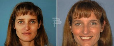 Rhinoplasty Before & After Gallery - Patient 192276889 - Image 1