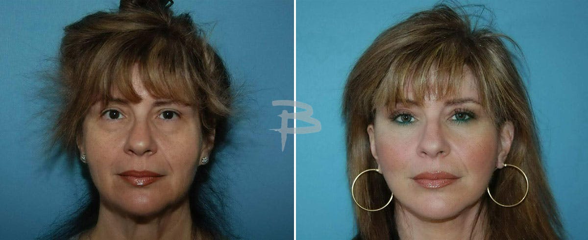 Facial Fat Grafting Before & After Gallery - Patient 192276888 - Image 1