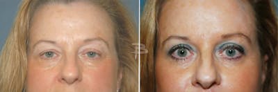 Blepharoplasty Before & After Gallery - Patient 192276890 - Image 1