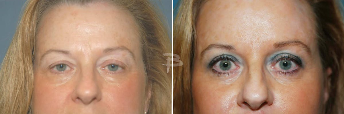Blepharoplasty Before & After Gallery - Patient 192276890 - Image 1