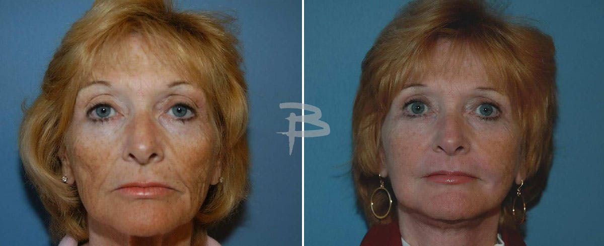 Facial Fat Grafting Before & After Gallery - Patient 192276892 - Image 1