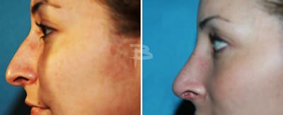 Rhinoplasty Before & After Gallery - Patient 192276893 - Image 1