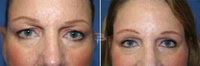 Blepharoplasty Before & After Gallery - Patient 192276897 - Image 1
