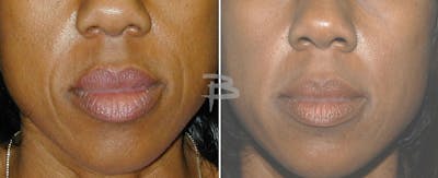 Facial Fat Grafting Before & After Gallery - Patient 192276898 - Image 1