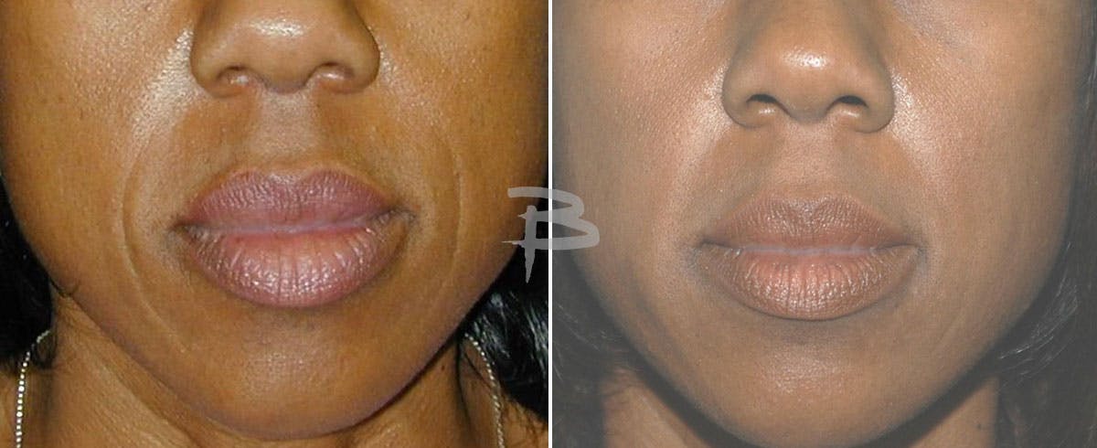 Facial Fat Grafting Before & After Gallery - Patient 192276898 - Image 1